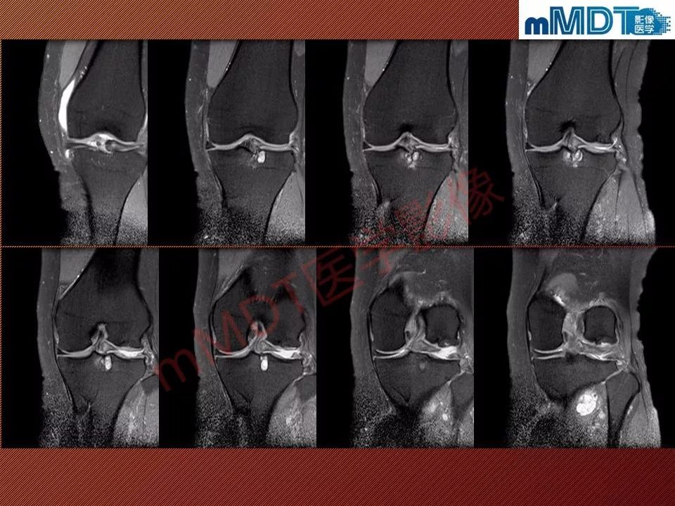 【PPT】半月板撕裂分型的MR诊断