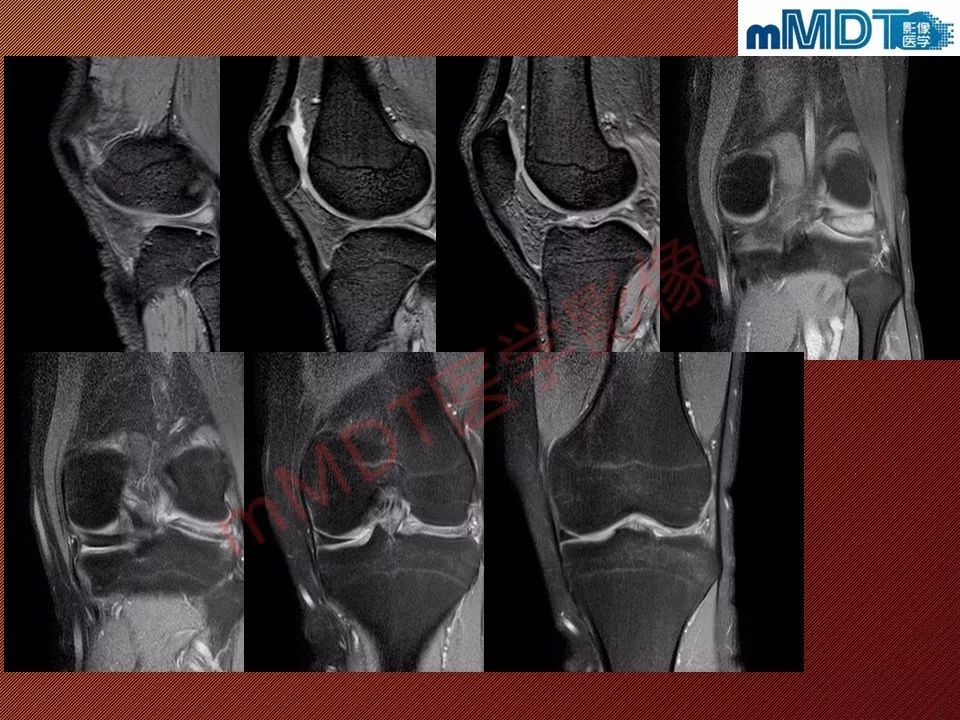 【PPT】半月板撕裂分型的MR诊断