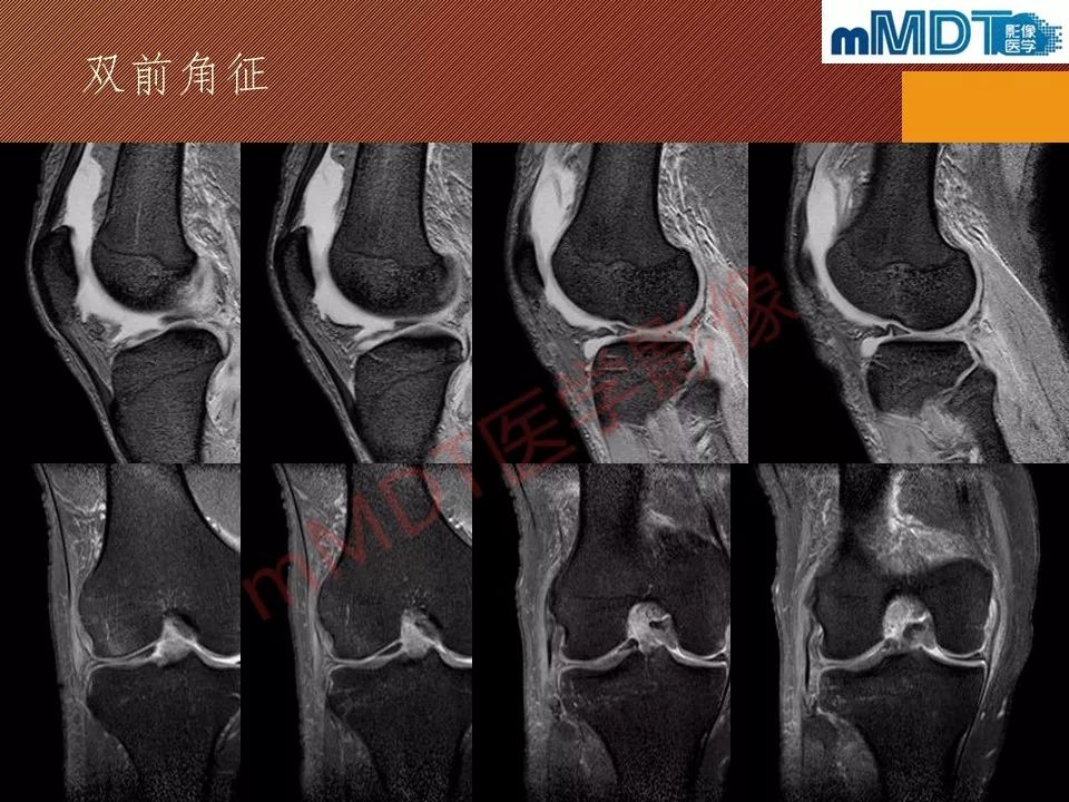 【PPT】半月板撕裂分型的MR诊断