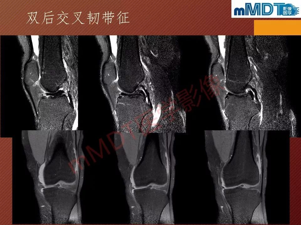 【PPT】半月板撕裂分型的MR诊断