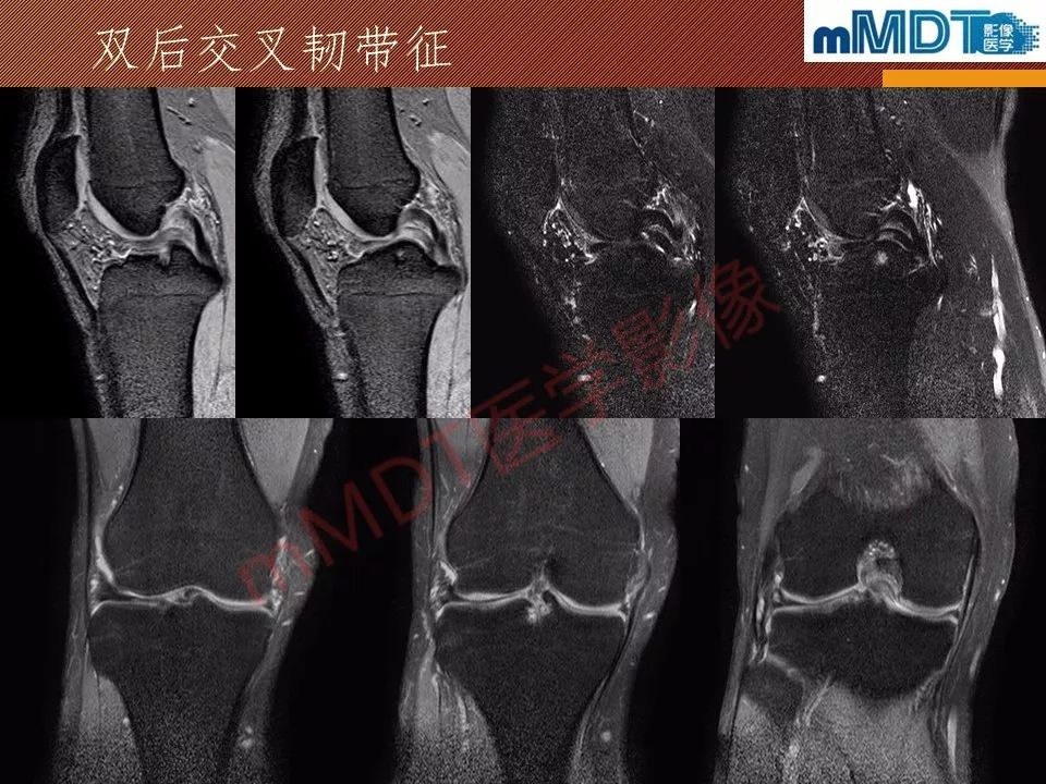 【PPT】半月板撕裂分型的MR诊断