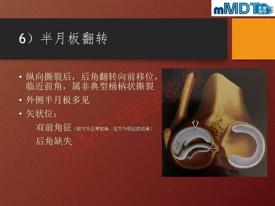 【PPT】半月板撕裂分型的MR诊断