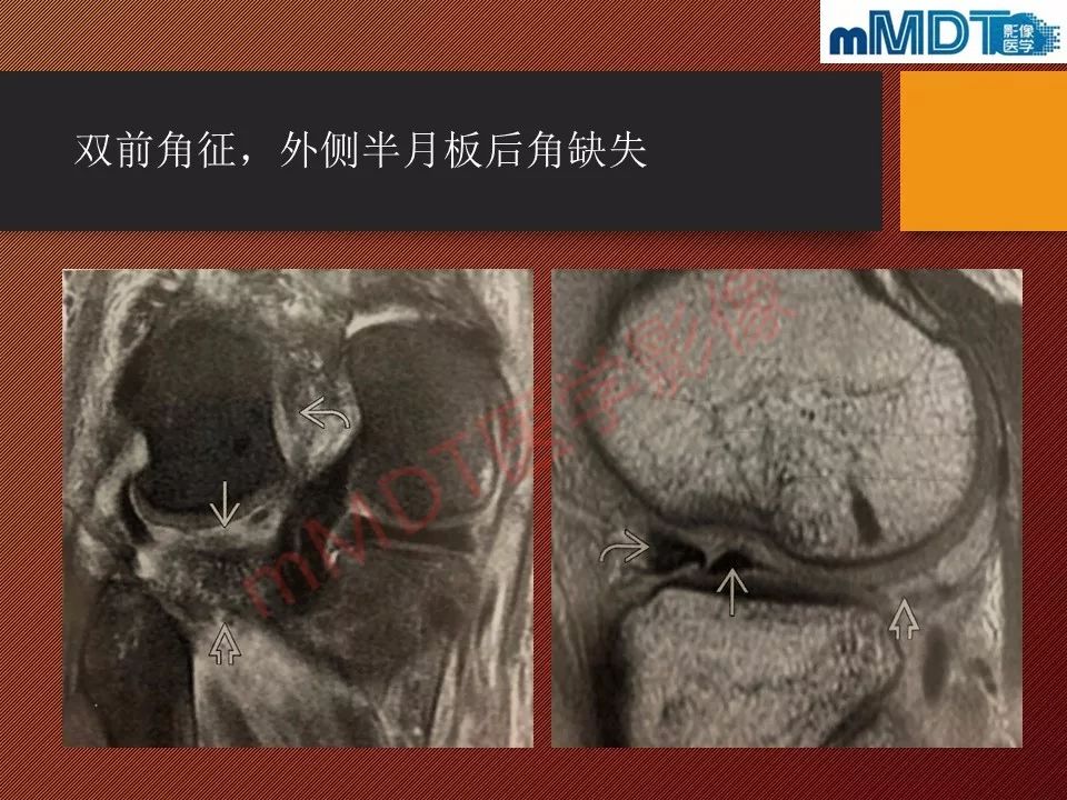 【PPT】半月板撕裂分型的MR诊断