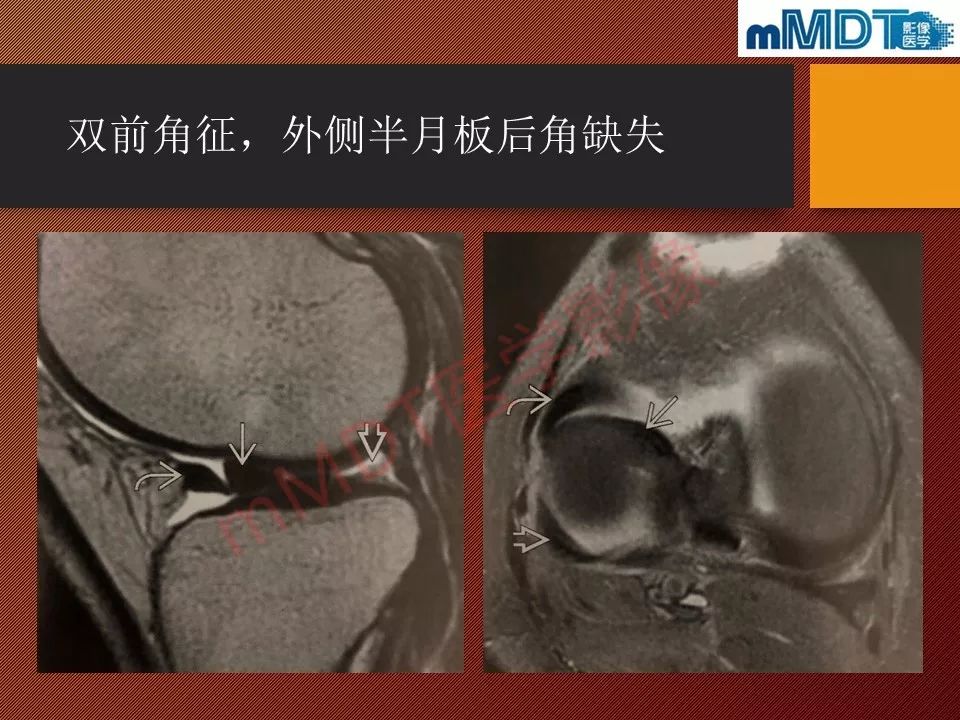 【PPT】半月板撕裂分型的MR诊断