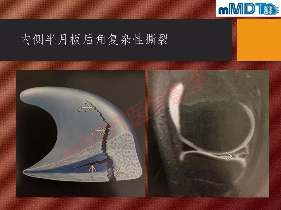 【PPT】半月板撕裂分型的MR诊断