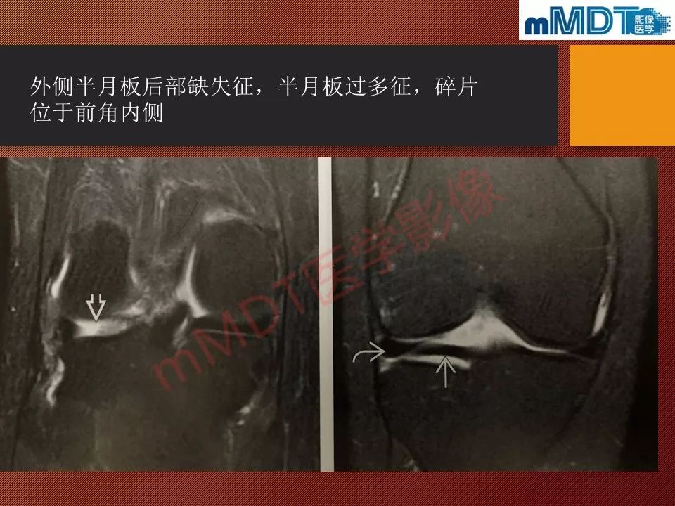 【PPT】半月板撕裂分型的MR诊断