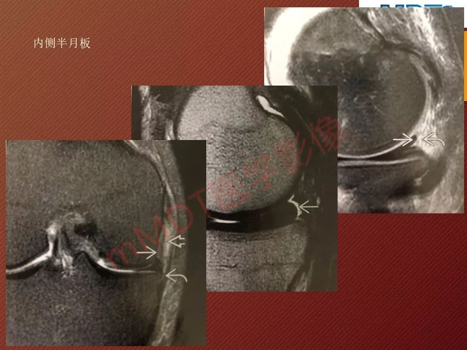 【PPT】半月板撕裂分型的MR诊断