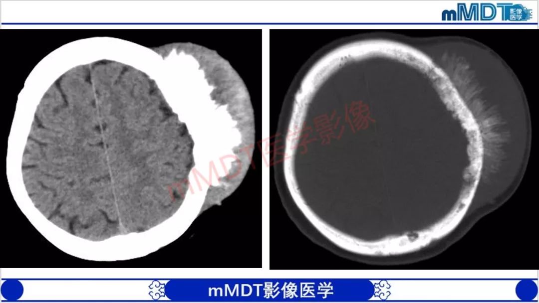 【PPT】颅骨“放射样”骨针的影像诊断