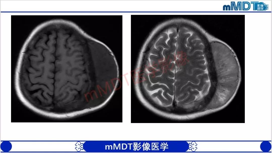 【PPT】颅骨“放射样”骨针的影像诊断