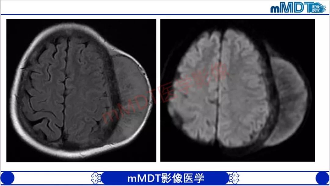 【PPT】颅骨“放射样”骨针的影像诊断