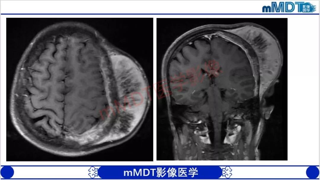 【PPT】颅骨“放射样”骨针的影像诊断