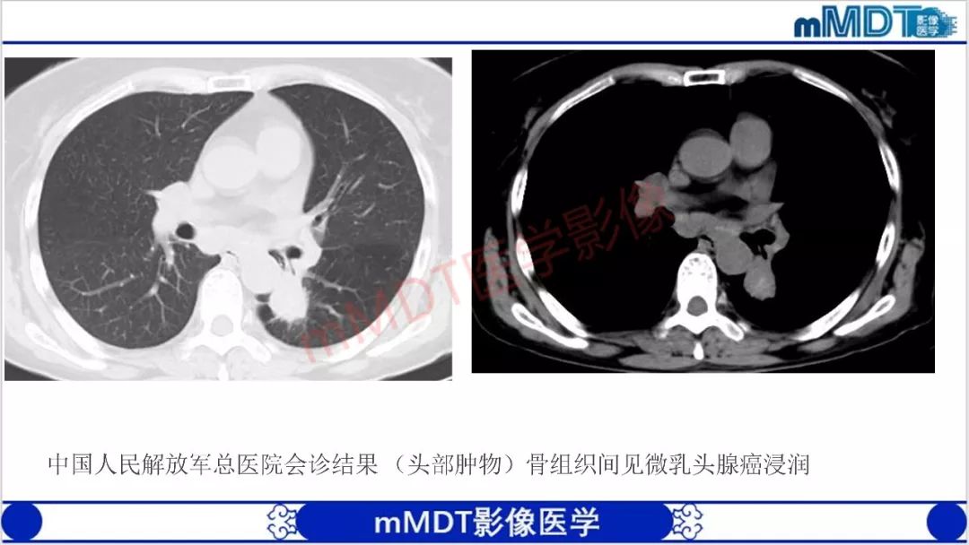 【PPT】颅骨“放射样”骨针的影像诊断