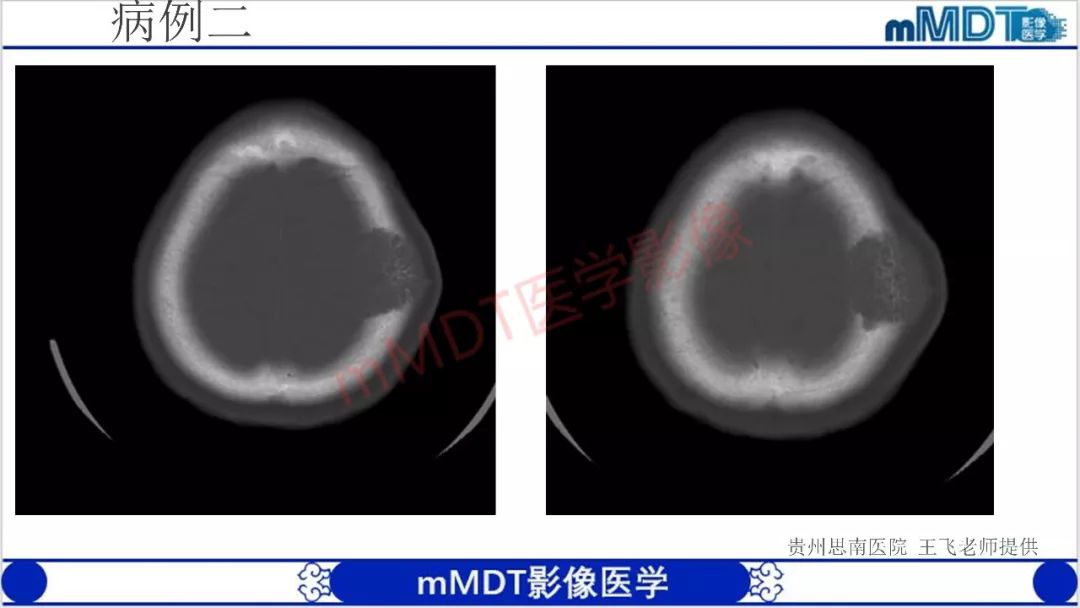 【PPT】颅骨“放射样”骨针的影像诊断