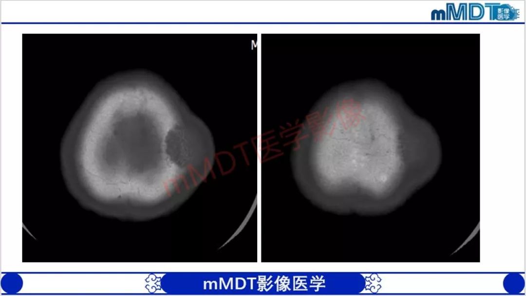 【PPT】颅骨“放射样”骨针的影像诊断