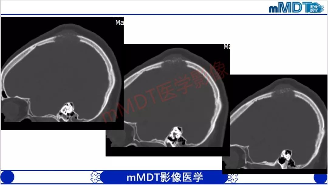 【PPT】颅骨“放射样”骨针的影像诊断