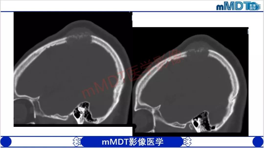 【PPT】颅骨“放射样”骨针的影像诊断