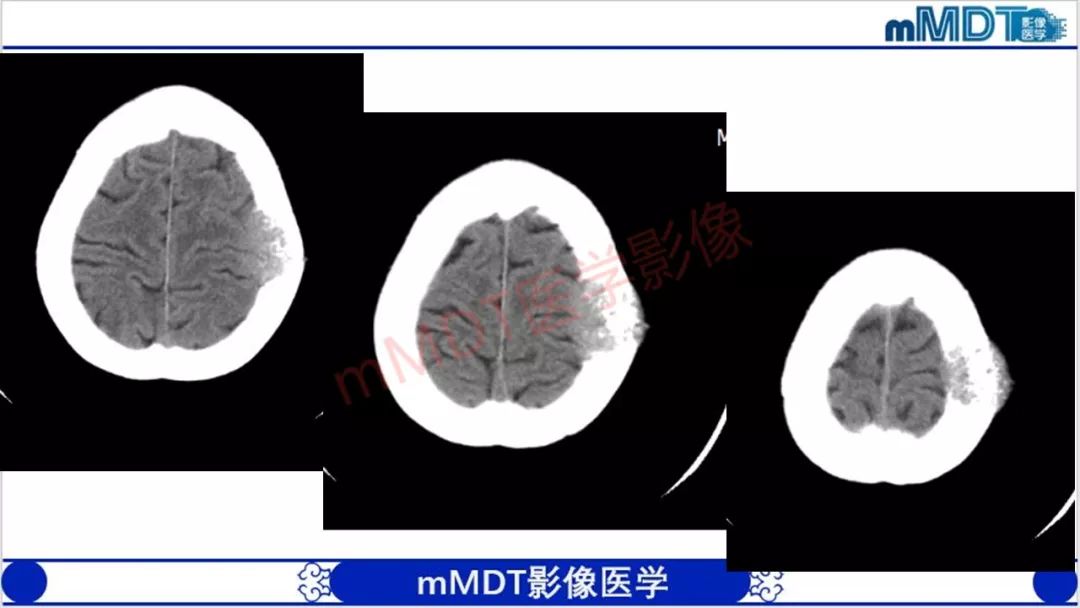 【PPT】颅骨“放射样”骨针的影像诊断