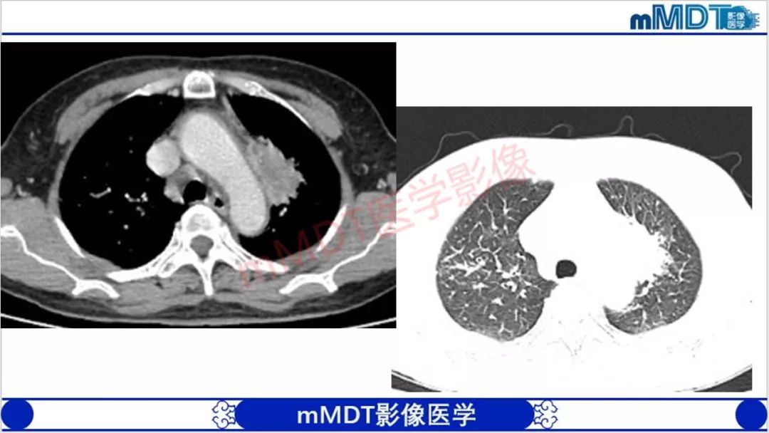 【PPT】颅骨“放射样”骨针的影像诊断