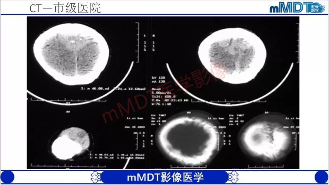 【PPT】颅骨“放射样”骨针的影像诊断