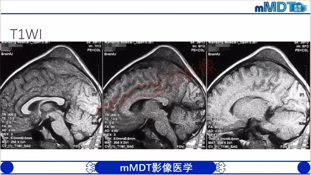 【PPT】颅骨“放射样”骨针的影像诊断