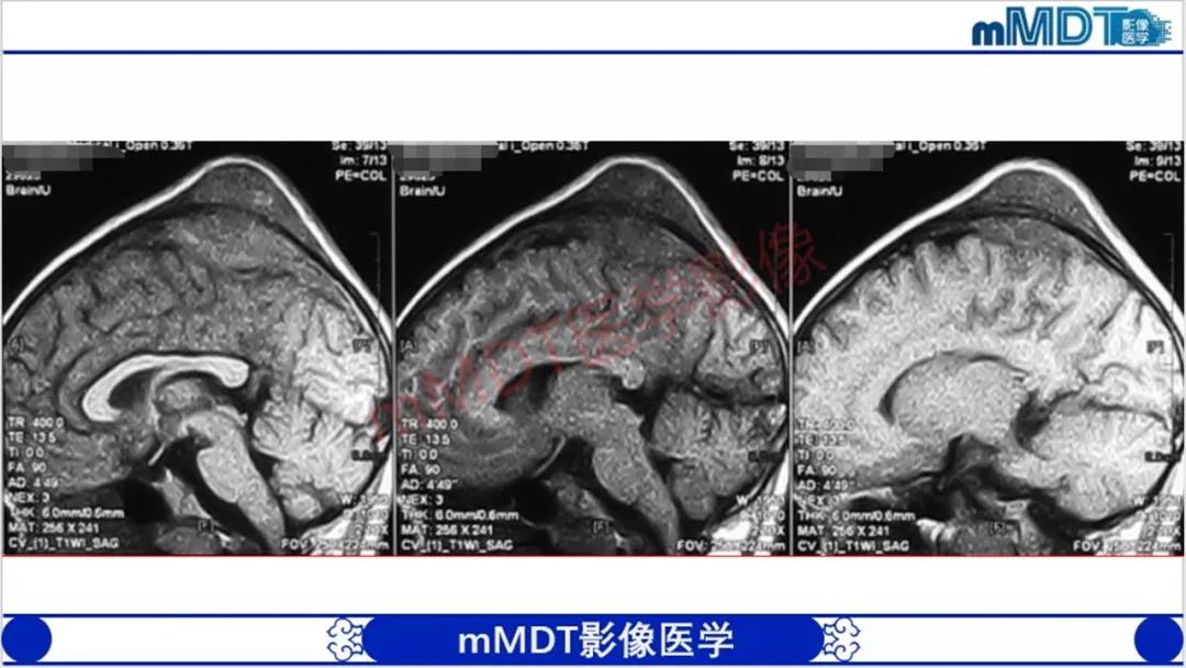 【PPT】颅骨“放射样”骨针的影像诊断