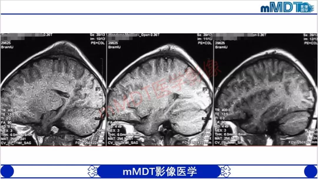 【PPT】颅骨“放射样”骨针的影像诊断