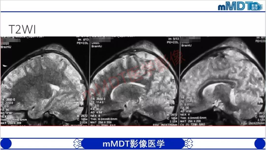 【PPT】颅骨“放射样”骨针的影像诊断