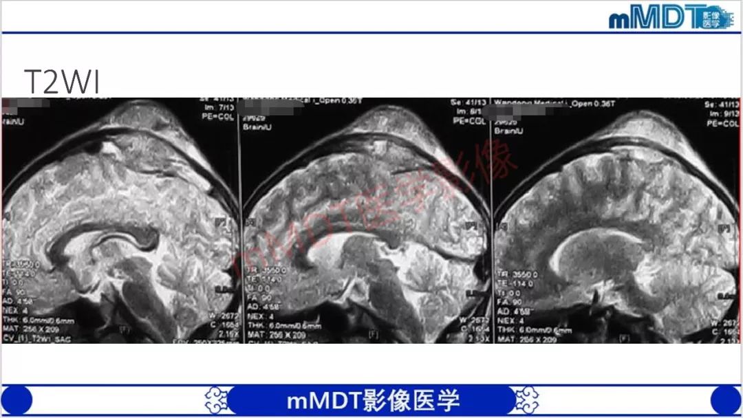 【PPT】颅骨“放射样”骨针的影像诊断