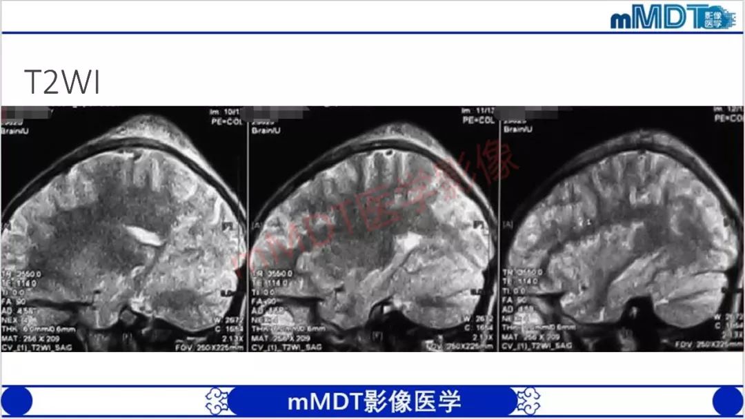 【PPT】颅骨“放射样”骨针的影像诊断