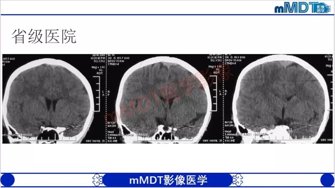 【PPT】颅骨“放射样”骨针的影像诊断