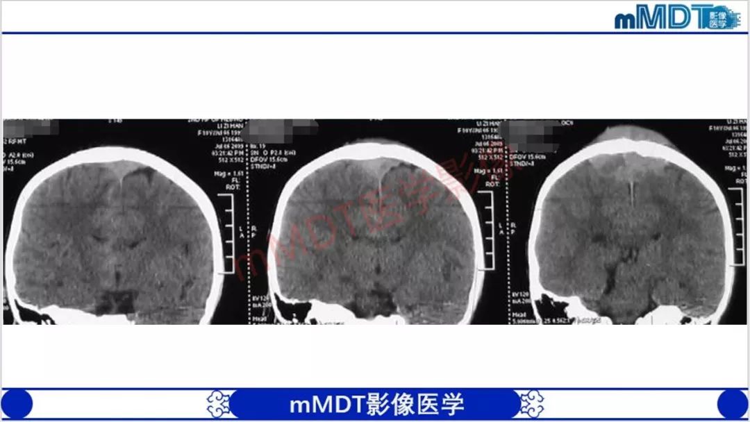 【PPT】颅骨“放射样”骨针的影像诊断