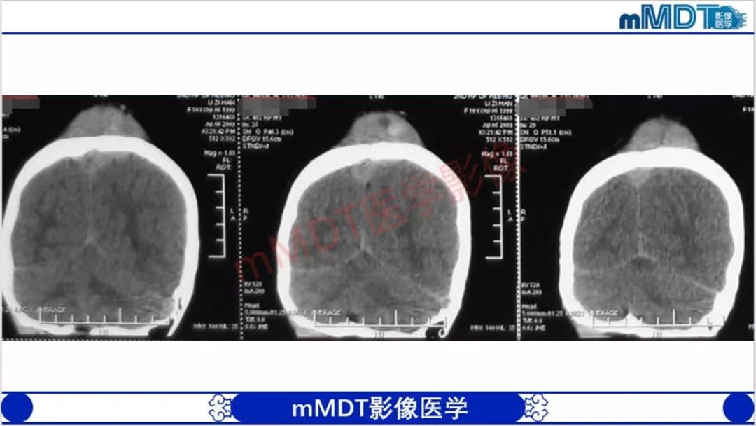 【PPT】颅骨“放射样”骨针的影像诊断