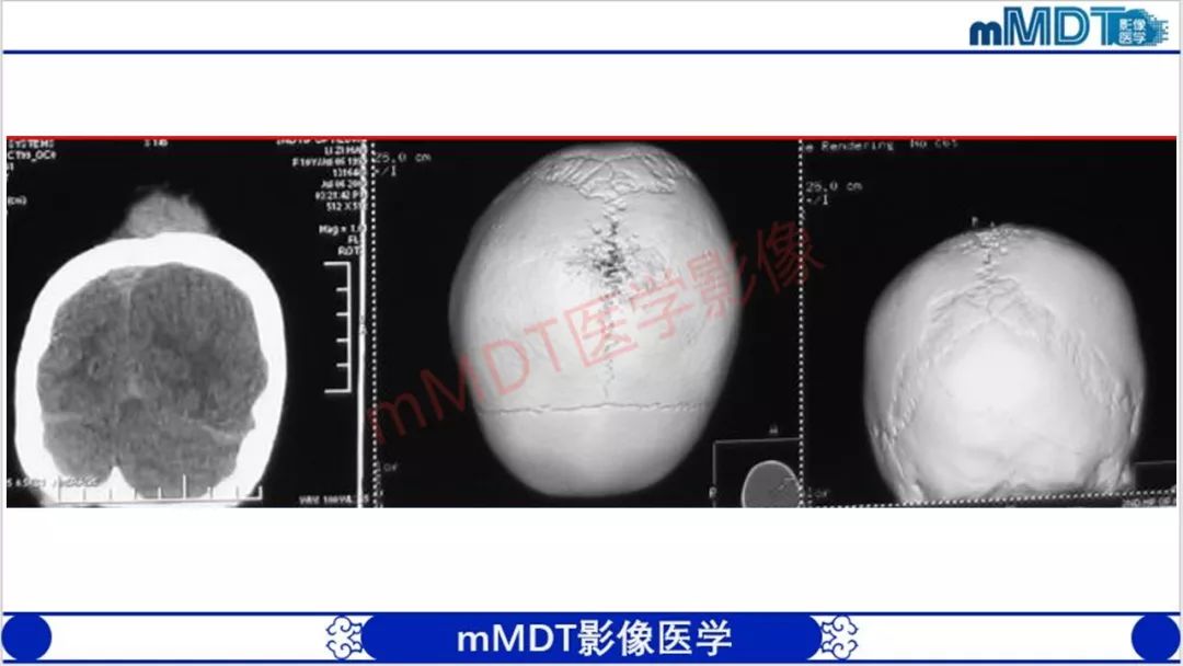 【PPT】颅骨“放射样”骨针的影像诊断