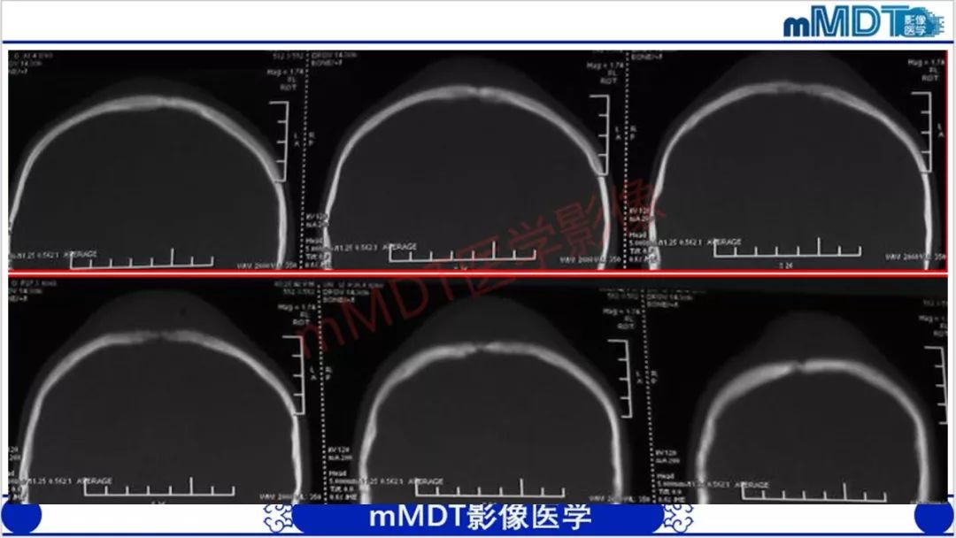【PPT】颅骨“放射样”骨针的影像诊断