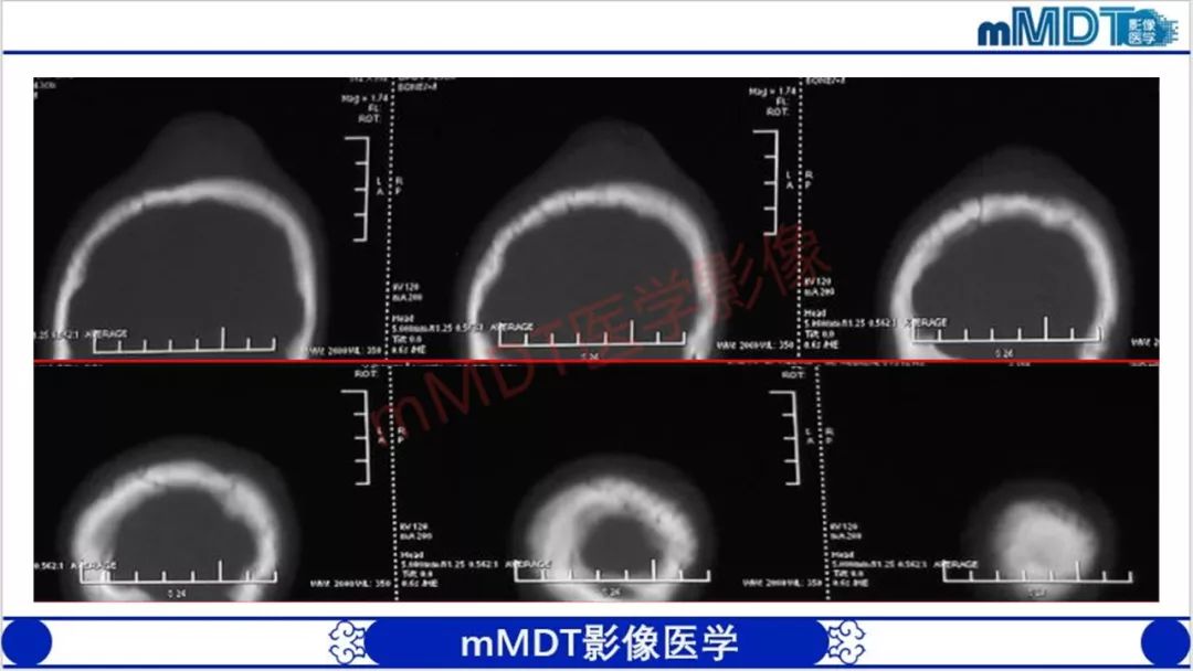 【PPT】颅骨“放射样”骨针的影像诊断