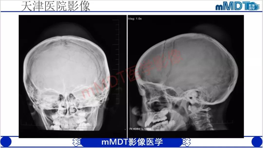 【PPT】颅骨“放射样”骨针的影像诊断