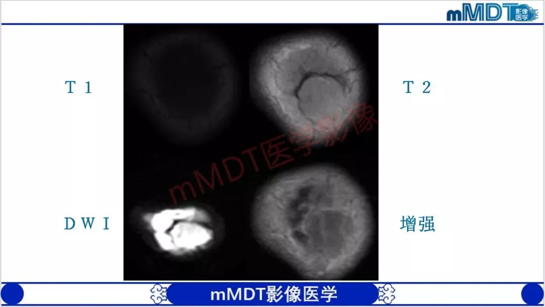【PPT】颅骨“放射样”骨针的影像诊断