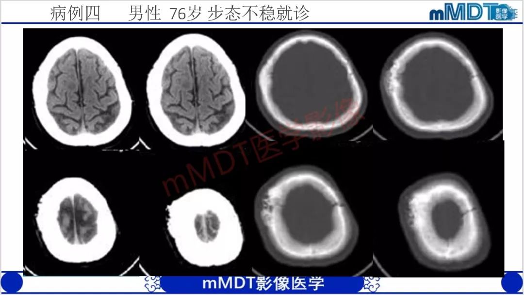 【PPT】颅骨“放射样”骨针的影像诊断