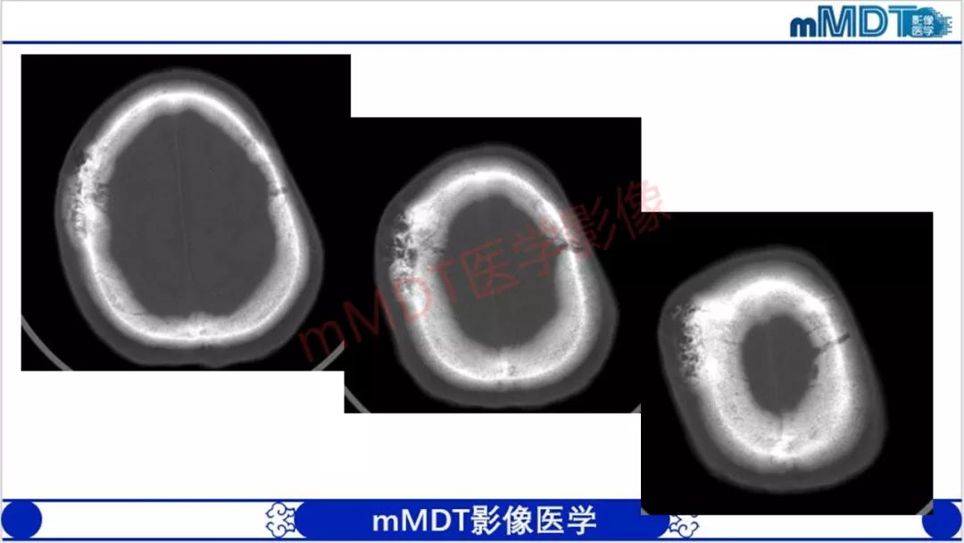 【PPT】颅骨“放射样”骨针的影像诊断