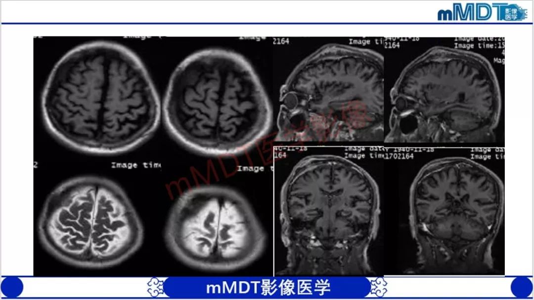 【PPT】颅骨“放射样”骨针的影像诊断