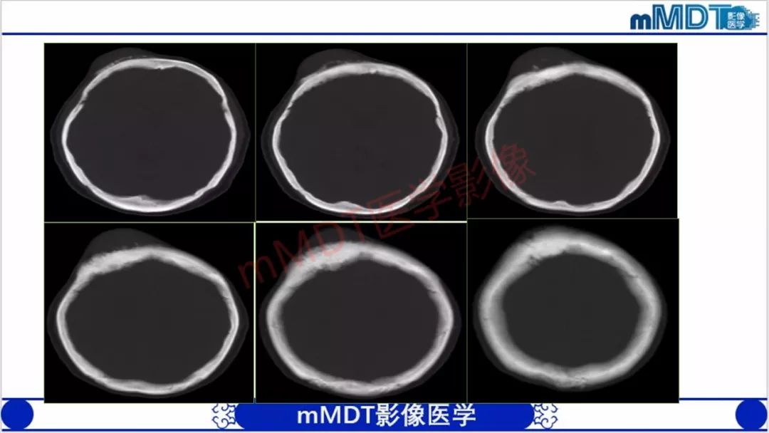 【PPT】颅骨“放射样”骨针的影像诊断