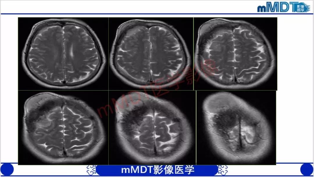 【PPT】颅骨“放射样”骨针的影像诊断