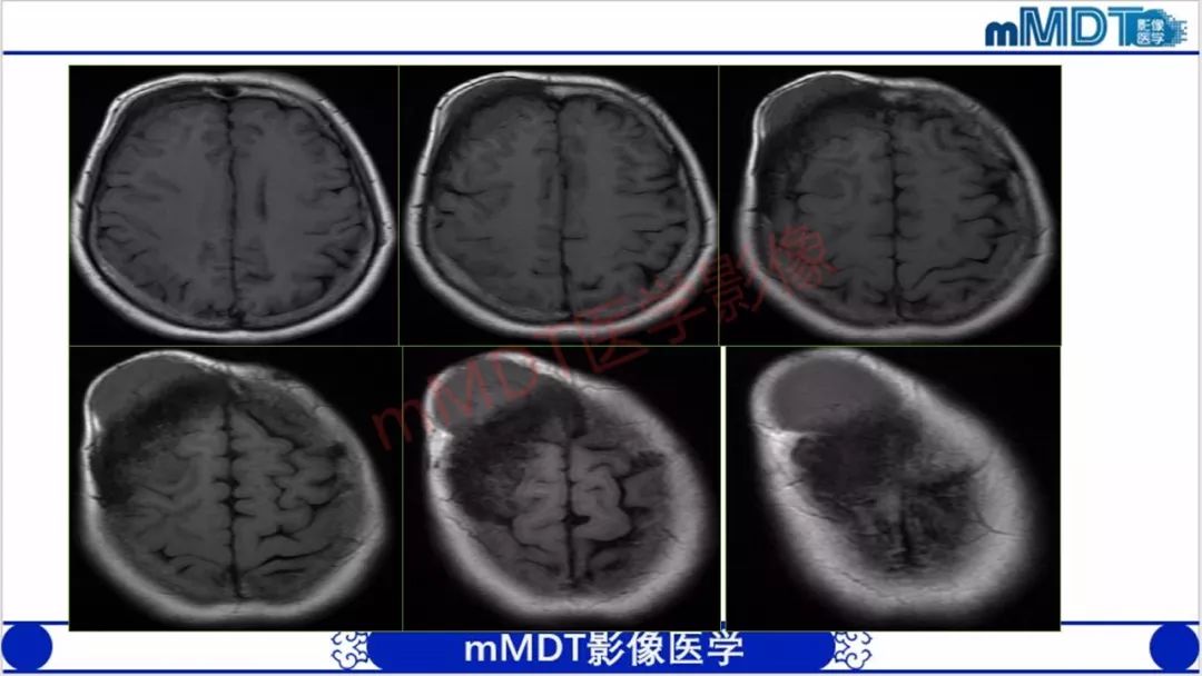 【PPT】颅骨“放射样”骨针的影像诊断