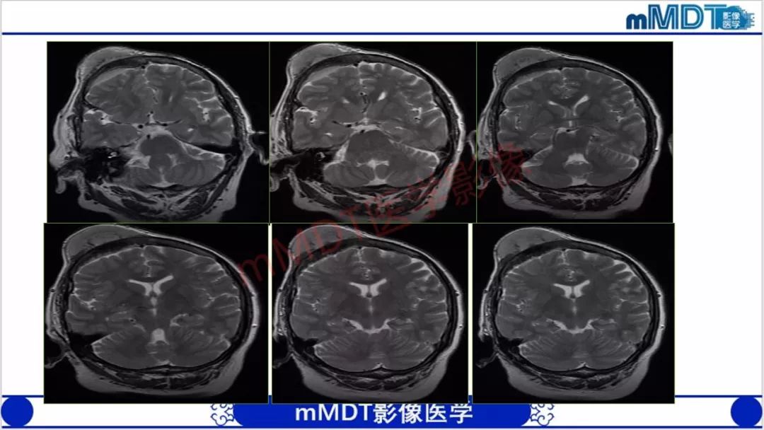【PPT】颅骨“放射样”骨针的影像诊断