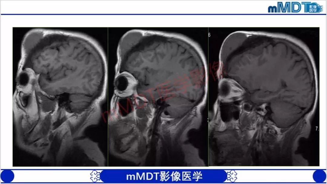 【PPT】颅骨“放射样”骨针的影像诊断