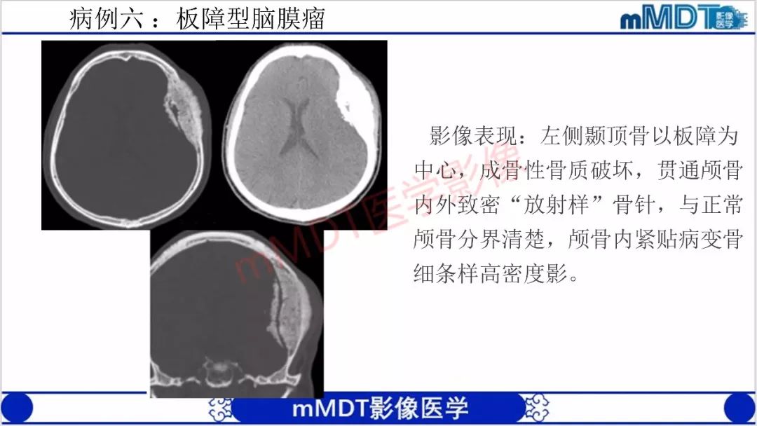 【PPT】颅骨“放射样”骨针的影像诊断