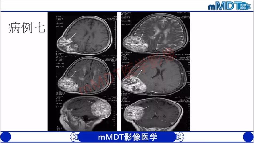 【PPT】颅骨“放射样”骨针的影像诊断