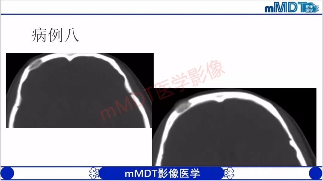 【PPT】颅骨“放射样”骨针的影像诊断