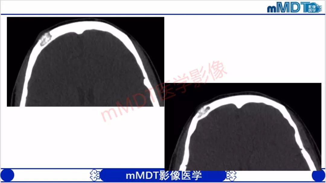 【PPT】颅骨“放射样”骨针的影像诊断