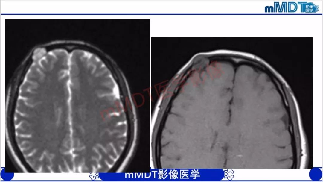 【PPT】颅骨“放射样”骨针的影像诊断